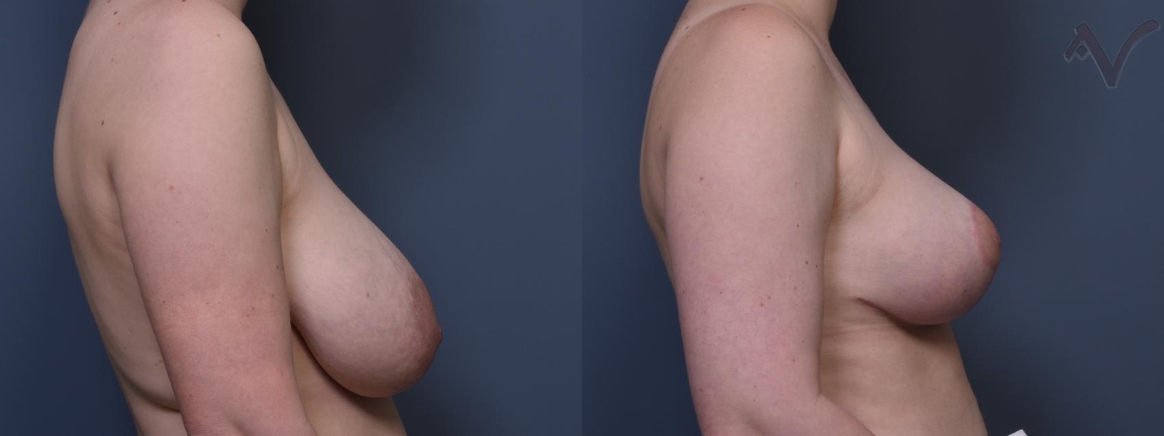 Before & After Breast Reduction Case 455 Right Side View in Los Angeles, CA