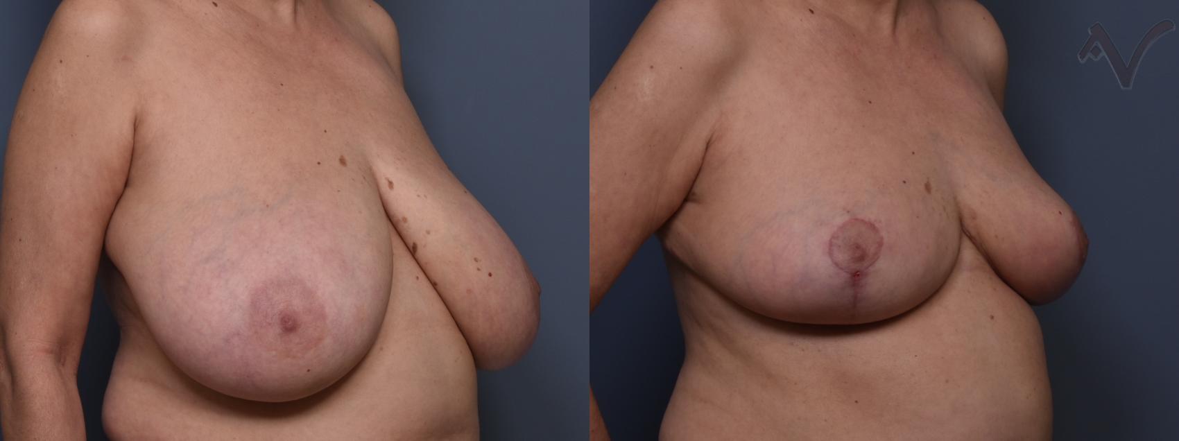 Before & After Breast Reduction Case 456 Right Oblique View in Los Angeles, CA