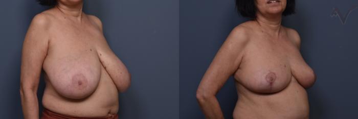 Before & After Breast Reduction Case 456 Right Oblique View in Los Angeles, CA