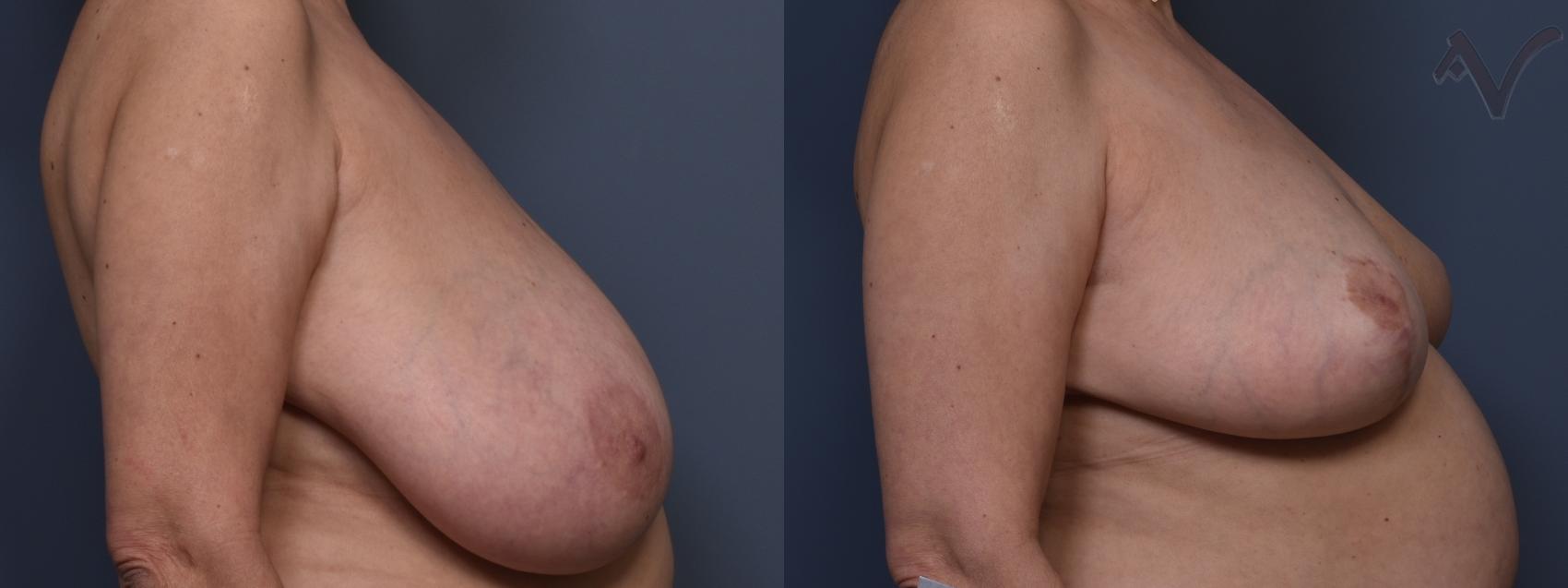 Before & After Breast Reduction Case 456 Right Side View in Los Angeles, CA
