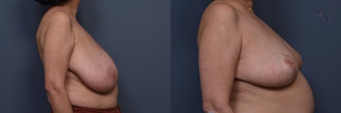 Before & After Breast Reduction Case 456 Right Side View in Los Angeles, CA