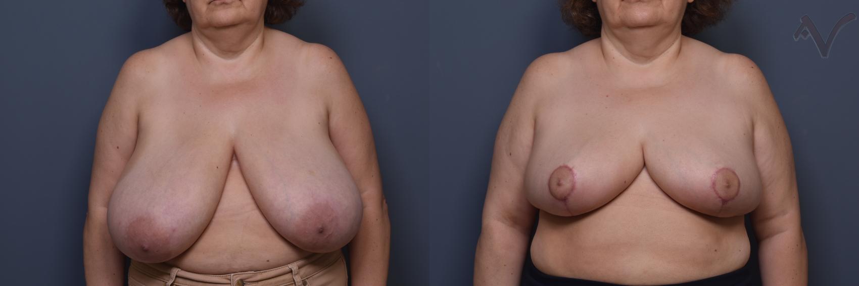 Before & After Breast Reduction Case 457 Front View in Los Angeles, CA