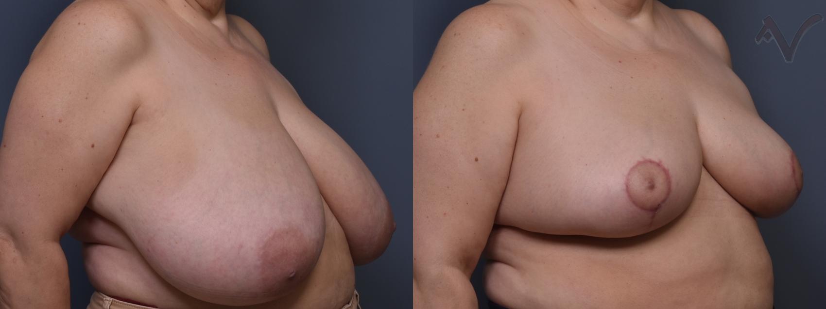 Before & After Breast Reduction Case 457 Right Oblique View in Los Angeles, CA