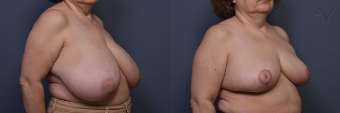 Before & After Breast Reduction Case 457 Right Oblique View in Los Angeles, CA
