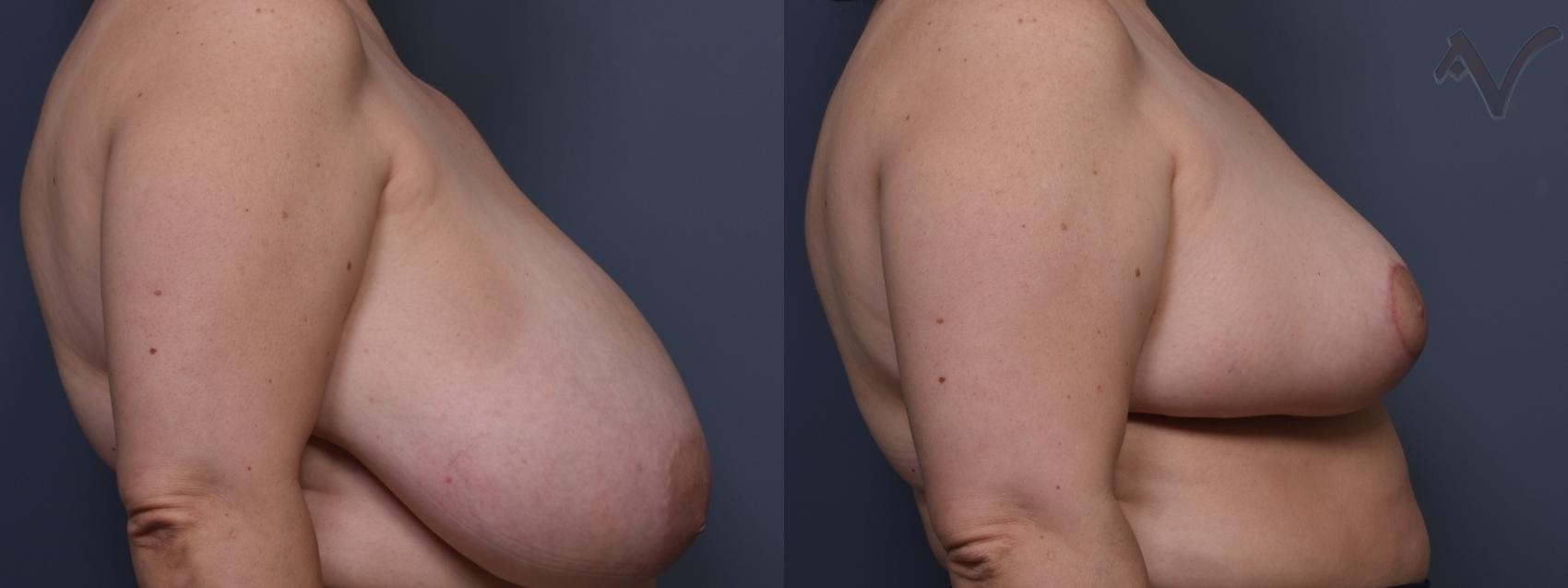 Before & After Breast Reduction Case 457 Right Side View in Los Angeles, CA
