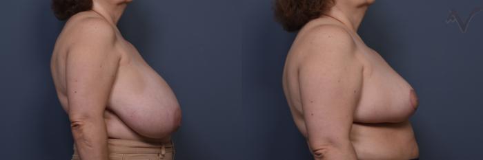 Before & After Breast Reduction Case 457 Right Side View in Los Angeles, CA