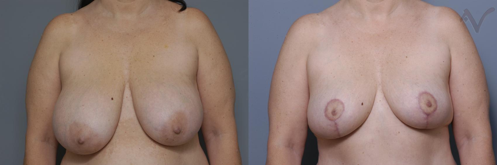Before & After Breast Reduction Case 458 Front View in Los Angeles, CA