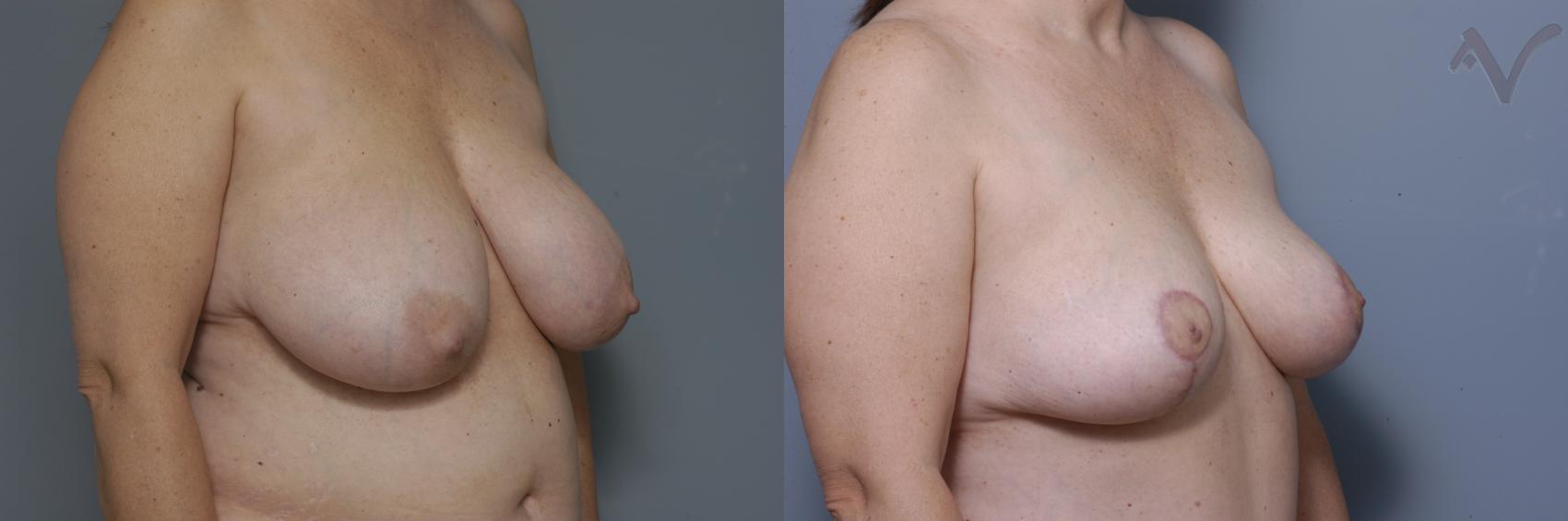 Before & After Breast Reduction Case 458 Right Oblique View in Los Angeles, CA