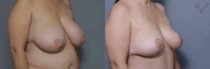 Before & After Breast Reduction Case 458 Right Oblique View in Los Angeles, CA