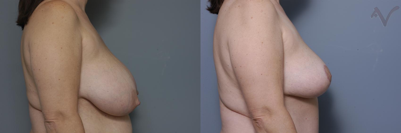 Before & After Breast Reduction Case 458 Right Side View in Los Angeles, CA