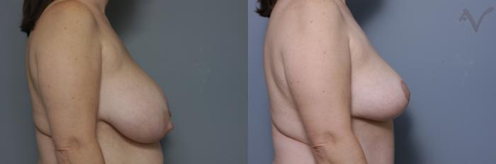 Before & After Breast Reduction Case 458 Right Side View in Los Angeles, CA