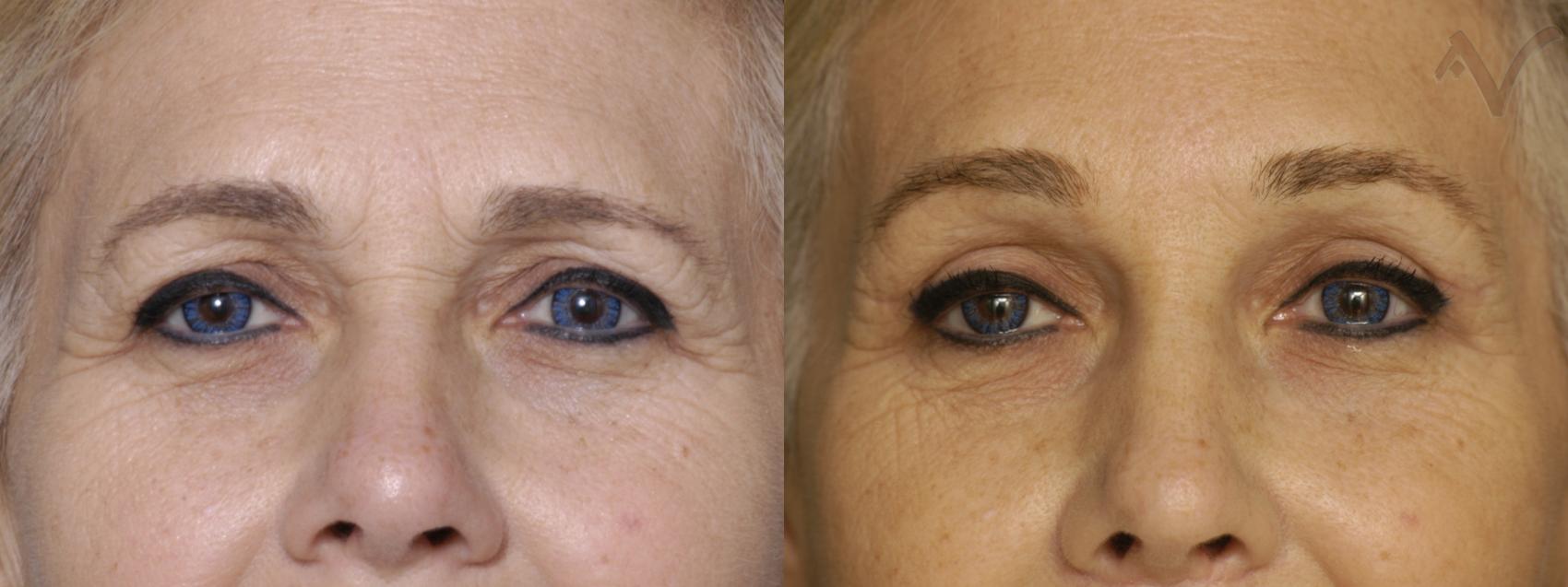 Before & After Browlift Case 339 Front View in Burbank, CA