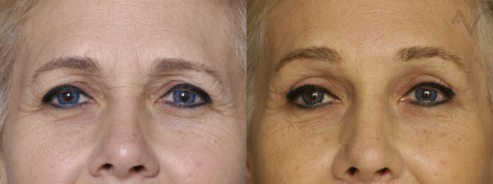 Before & After Browlift Case 339 Front View in Los Angeles, CA