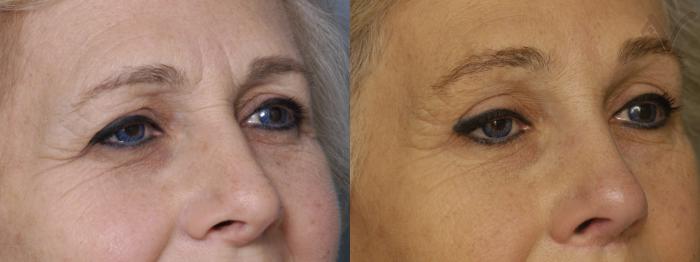 Before & After Browlift Case 339 Right Oblique View in Los Angeles, CA