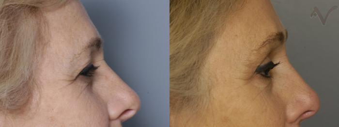 Before & After Browlift Case 339 Right Side View in Los Angeles, CA