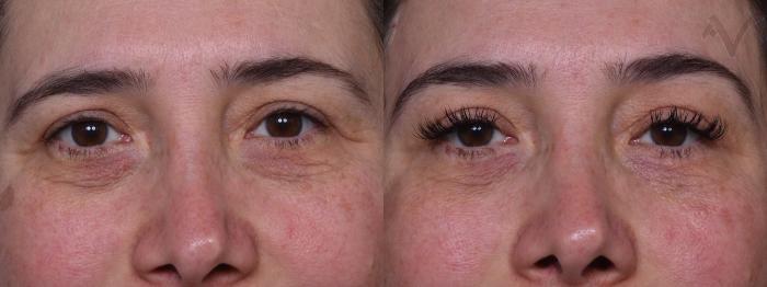 Before & After Browlift Case 386 Front View in Los Angeles, CA