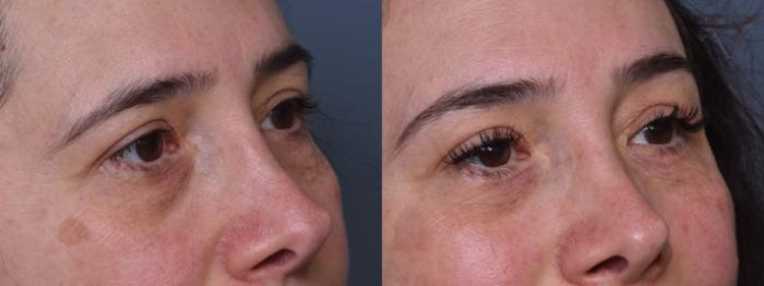 Before & After Browlift Case 386 Right Oblique View in Los Angeles, CA