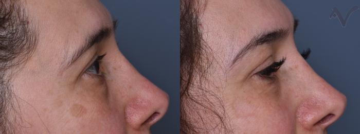 Before & After Browlift Case 386 Right Side View in Los Angeles, CA