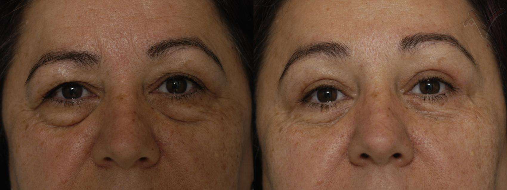 Before & After Eyelid Surgery Case 61 Front View in Burbank, CA