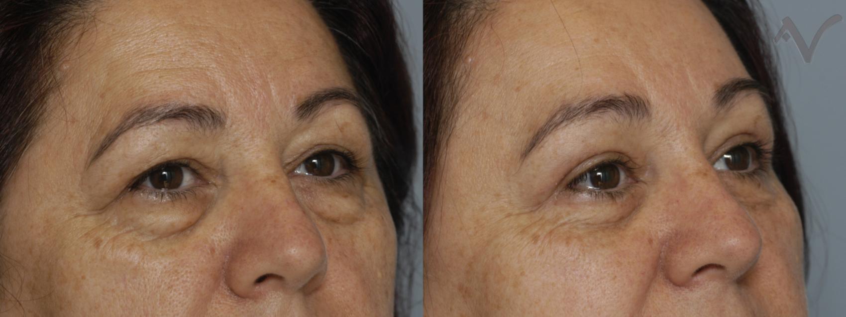 Before & After Browlift Case 61 Right Oblique View in Los Angeles, CA