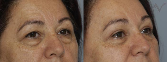Before & After Combined Upper & Lower Eyelid Surgery Case 61 Right Oblique View in Los Angeles, CA