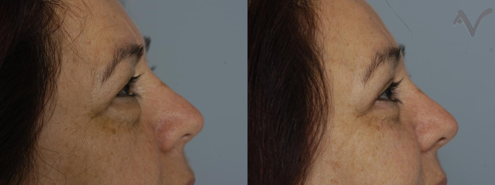 Before & After Browlift Case 61 Right Side View in Los Angeles, CA