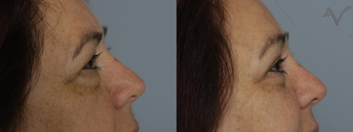 Before & After Combined Upper & Lower Eyelid Surgery Case 61 Right Side View in Los Angeles, CA