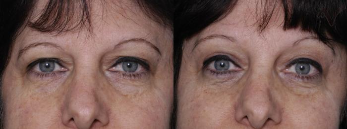 Before & After Combined Upper & Lower Eyelid Surgery Case 62 Front View in Los Angeles, CA