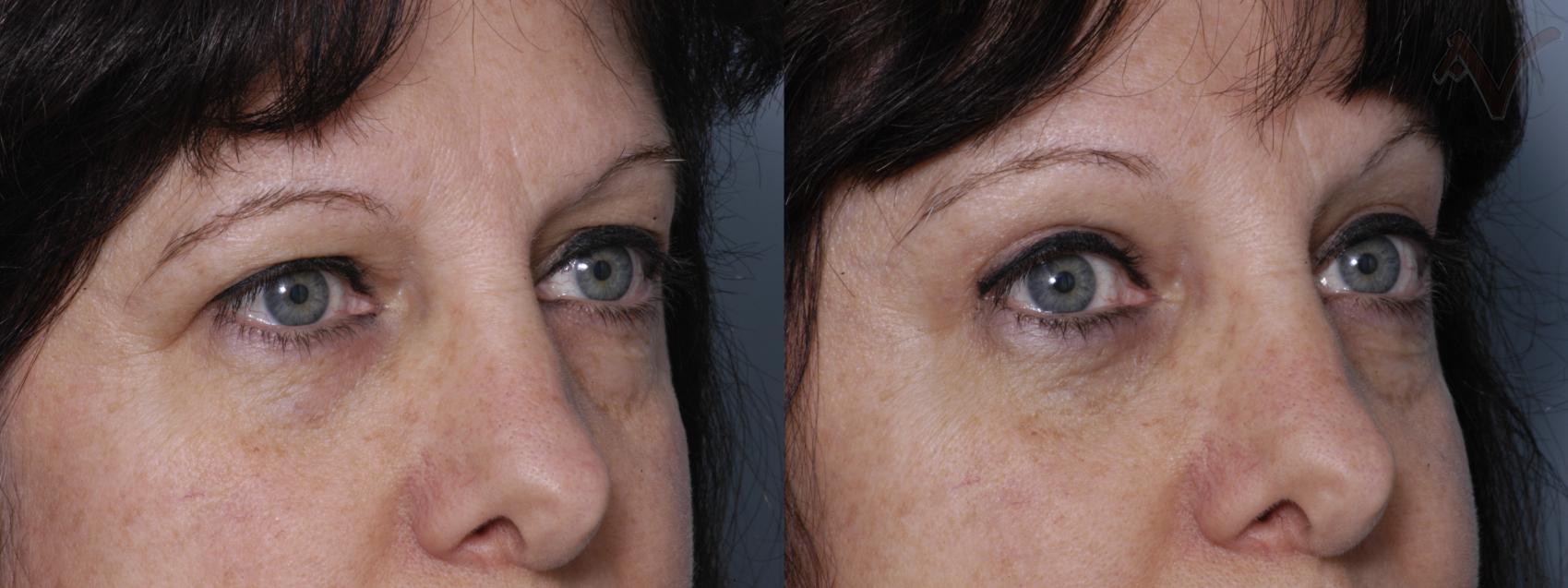 Before & After Eyelid Surgery Case 62 Right Oblique View in Burbank, CA