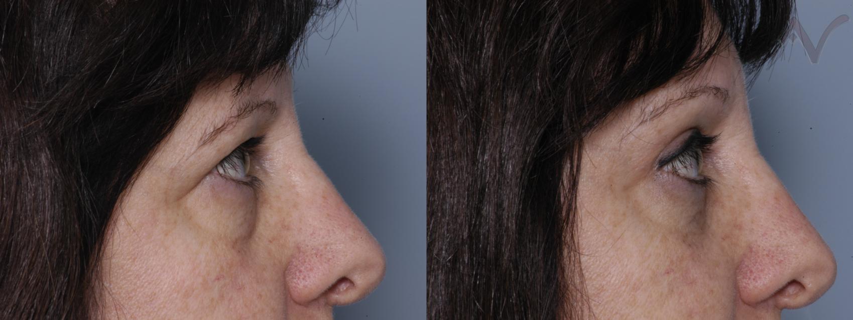Before & After Browlift Case 62 Right Side View in Burbank, CA