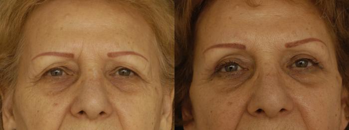 Before & After Browlift Case 63 Front View in Los Angeles, CA