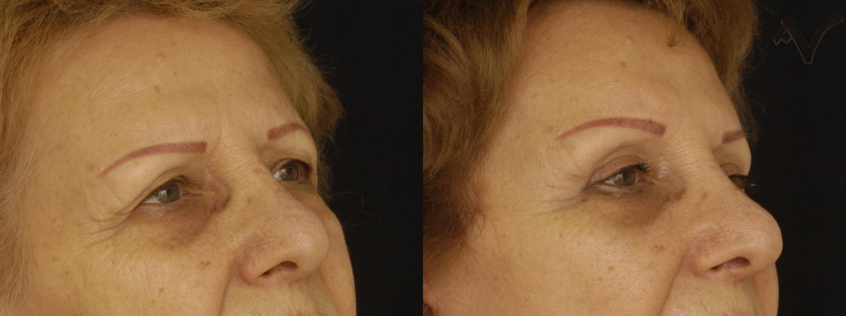 Before & After Browlift Case 63 Right Oblique View in Los Angeles, CA