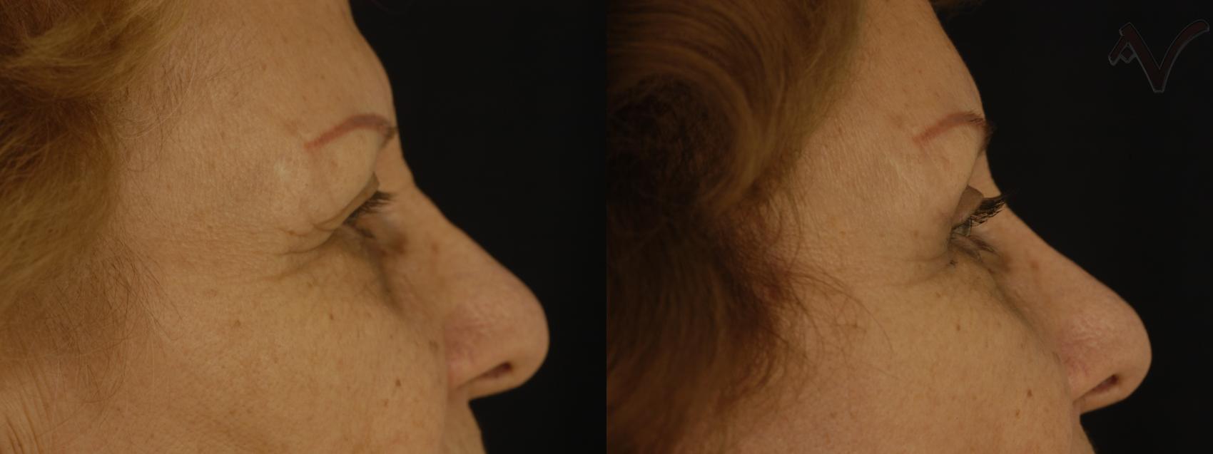 Before & After Browlift Case 63 Right Side View in Los Angeles, CA