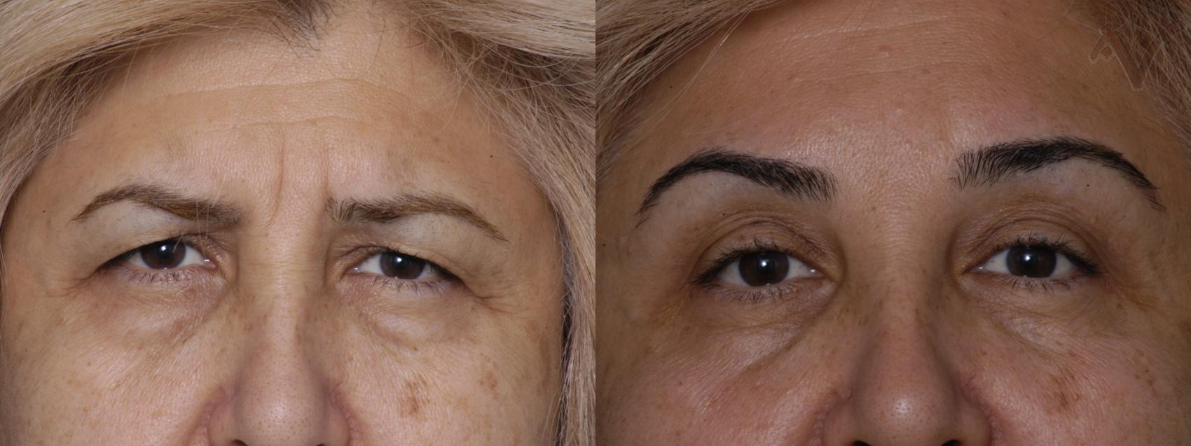 Before & After Browlift Case 64 Front View in Los Angeles, CA