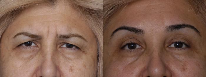 Before & After Combined Upper & Lower Eyelid Surgery Case 64 Front View in Los Angeles, CA