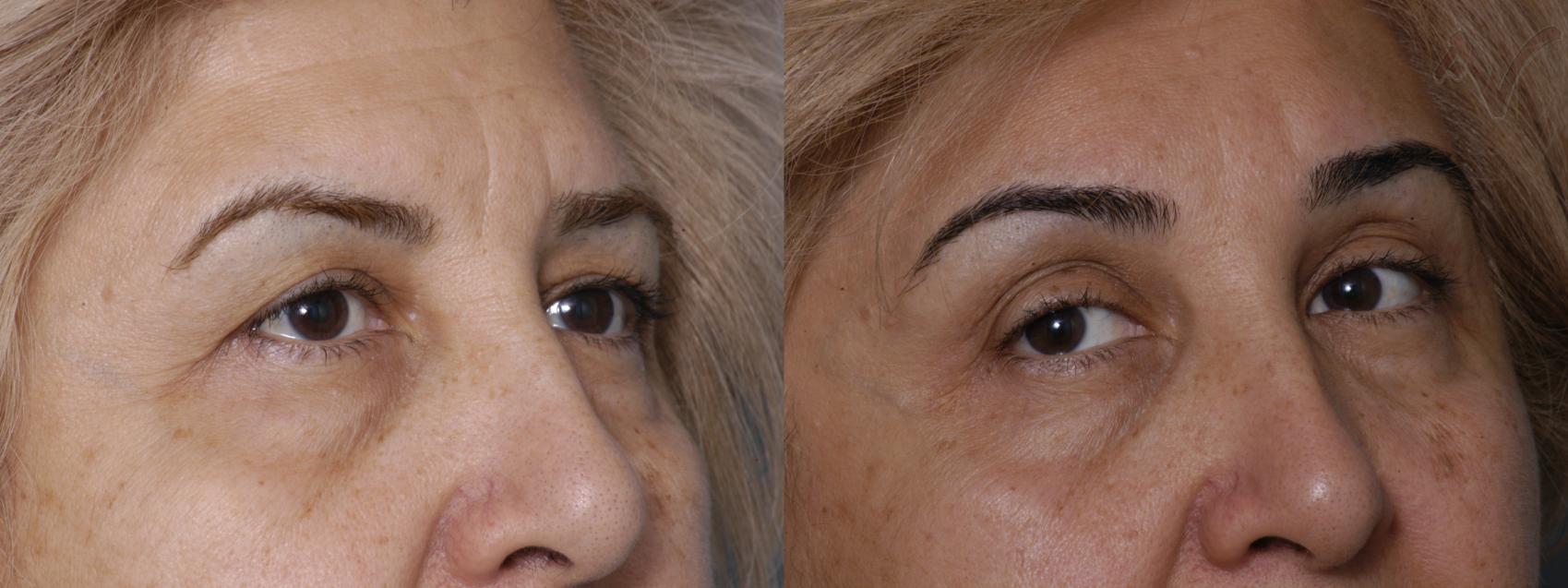 Before & After Browlift Case 64 Right Oblique View in Burbank, CA