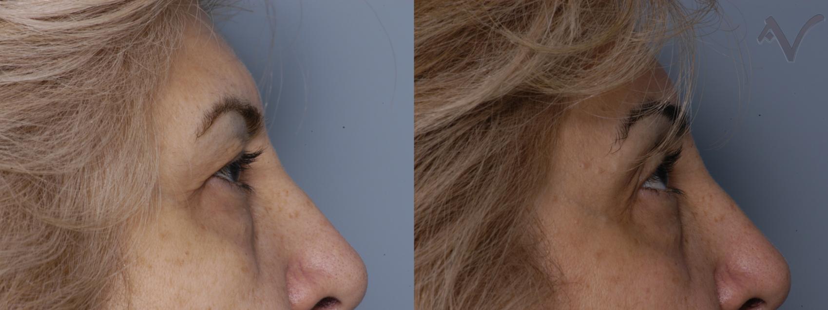 Before & After Browlift Case 64 Right Side View in Los Angeles, CA