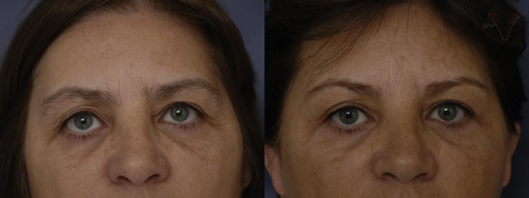 Before & After Browlift Case 66 Front View in Burbank, CA