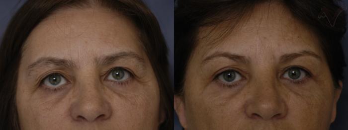 Before & After Upper Eyelid Surgery Case 66 Front View in Los Angeles, CA