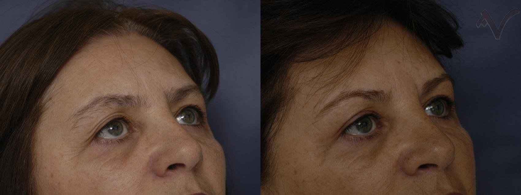 Before & After Browlift Case 66 Right Oblique View in Los Angeles, CA