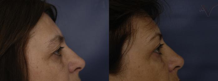 Before & After Browlift Case 66 Right Side View in Los Angeles, CA