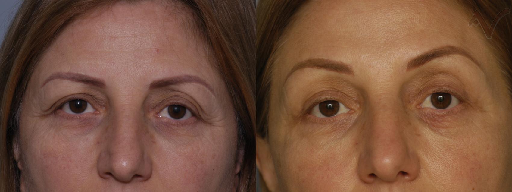Before & After Browlift Case 67 Front View in Burbank, CA