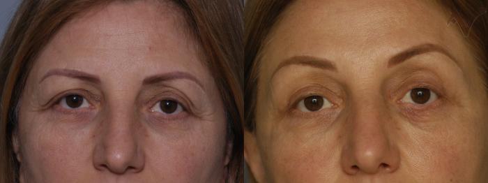 Before & After Upper Eyelid Surgery Case 67 Front View in Los Angeles, CA