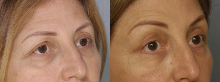 Before & After Browlift Case 67 Right Oblique View in Los Angeles, CA