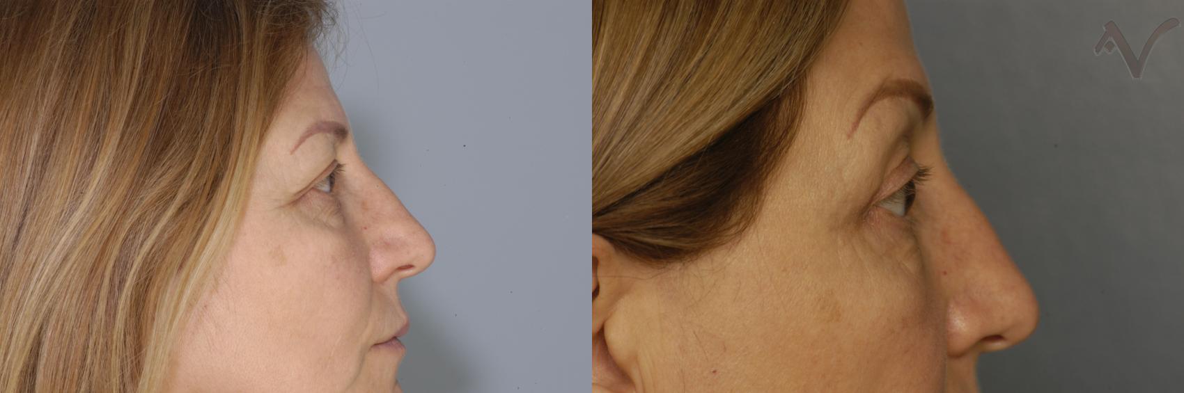 Before & After Browlift Case 67 Right Side View in Los Angeles, CA