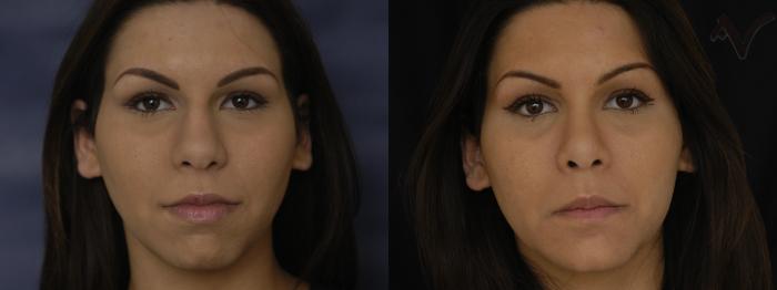 Before & After Rhinoplasty Case 395 Front View in Los Angeles, CA