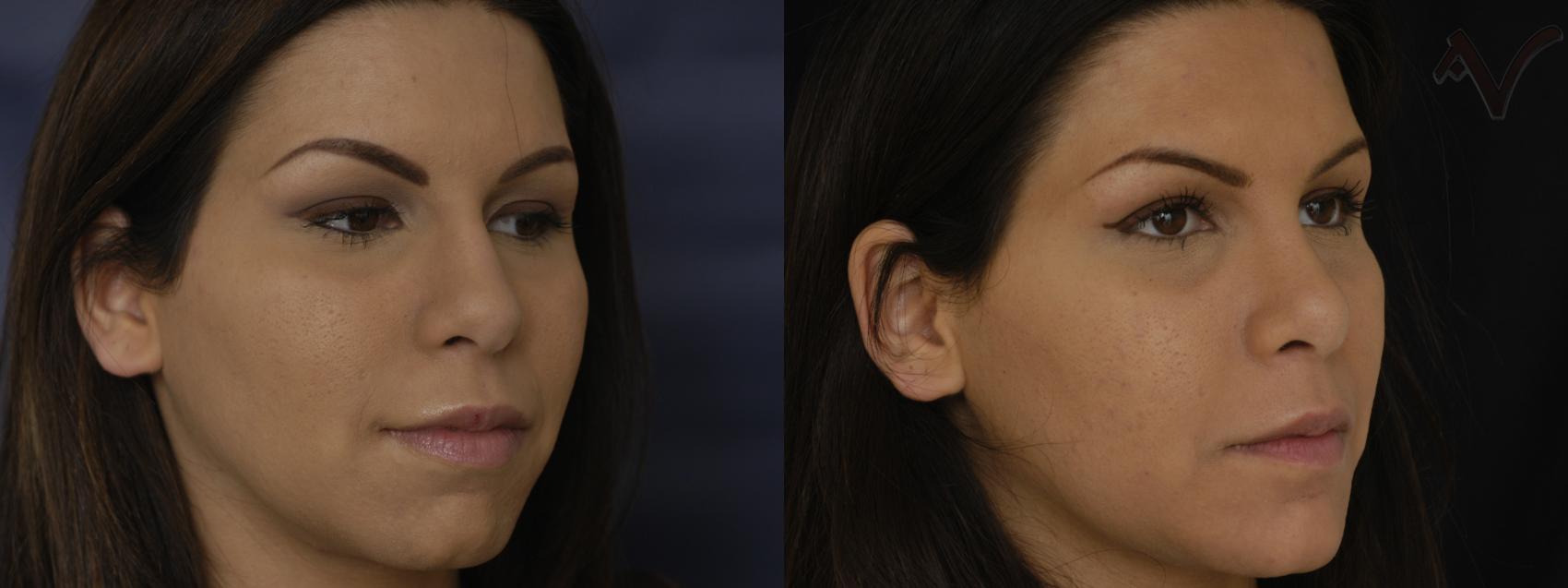 Before & After Chin Implant Case 395 Right Oblique View in Los Angeles, CA