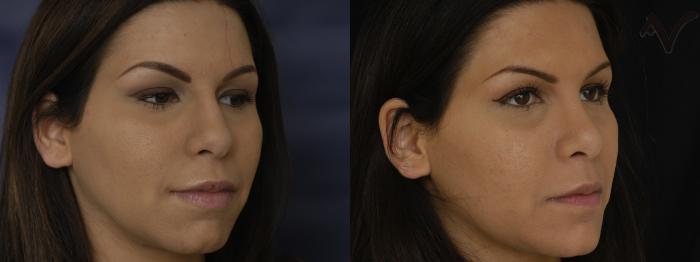Before & After Chin Implant Case 395 Right Oblique View in Los Angeles, CA