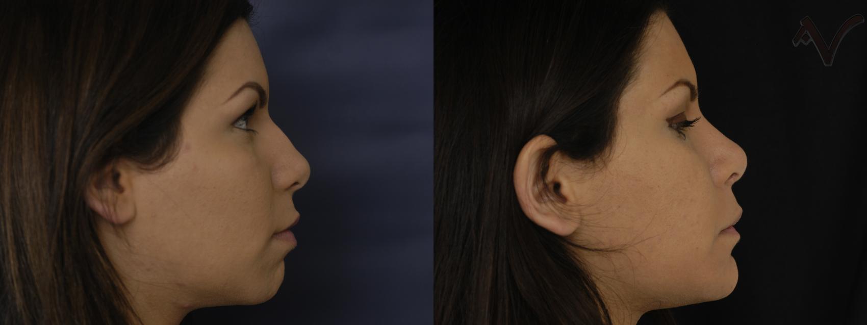 Before & After Chin Implant Case 395 Right Side View in Los Angeles, CA
