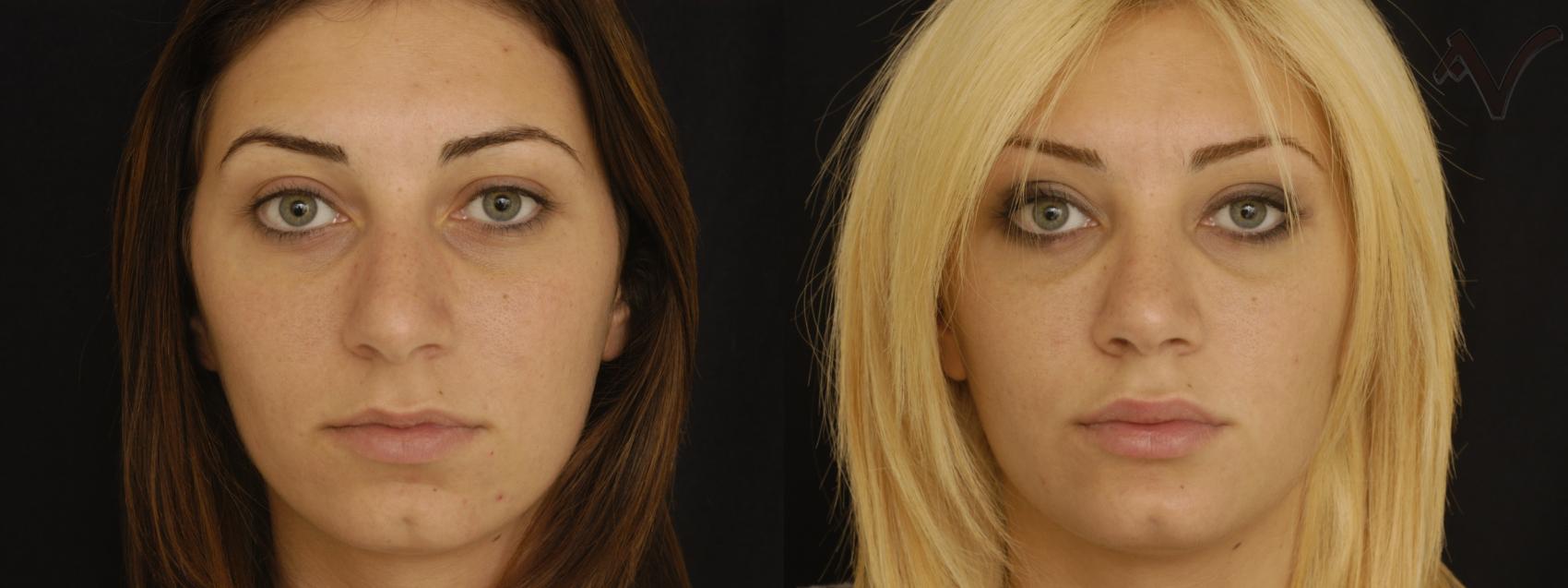 Before & After Rhinoplasty Case 74 Front View in Los Angeles, CA